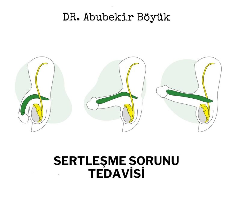 Sertleşme Sorunu - drabubekir