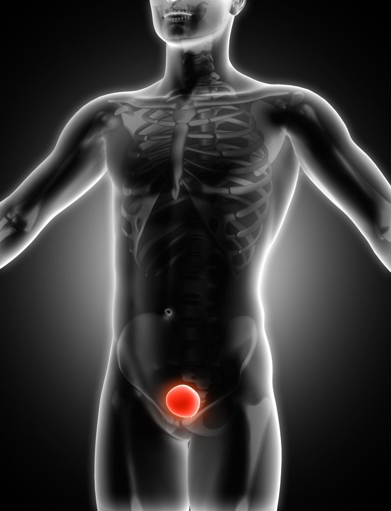 HİDROSEL (SU FITIĞI)