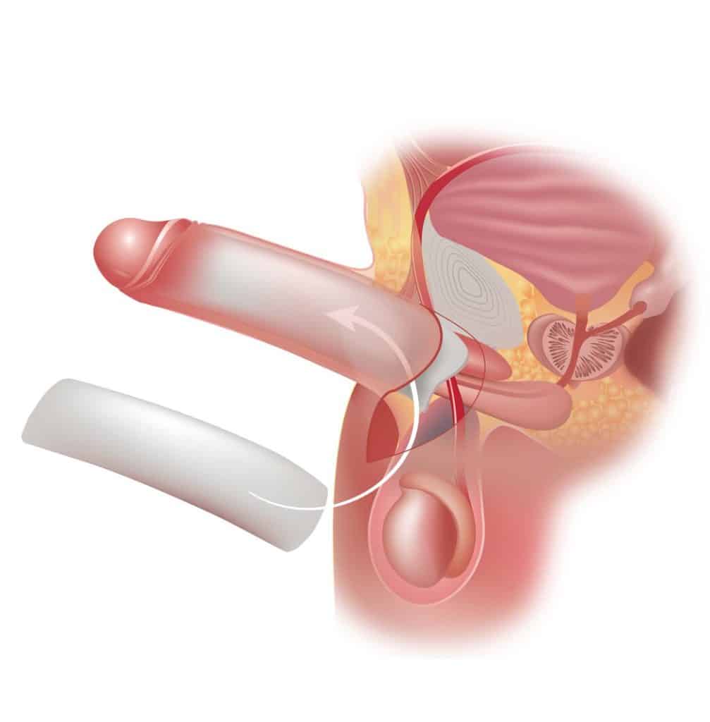 ameliyatsız penis kalınlaştırma